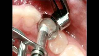 Amalgam Fillings Procedure  Lake Merritt Dental Oakland CA [upl. by Walczak175]