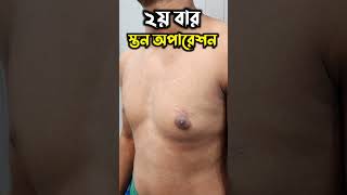 Second Time Gynecomastia Surgery Bd [upl. by Enilada959]