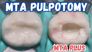 MTA PULPOTOMY 🟡 Pulpotomy with MTA PLUS 🟢 Step By Step [upl. by Cornelie]