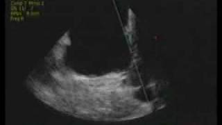 intracardiac echocardiography ICE [upl. by Ploch]