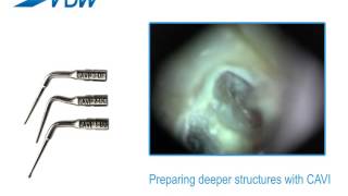 VDW Dental · How To VDWULTRA  Preparing deeper structures with CAVI [upl. by Sukram]