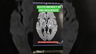 Acute Infarct in Brain Mri brain sequence pathology [upl. by Huston]