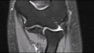 Lateral epicondylitis of elbow [upl. by Alan114]