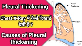 pleural thickening of the lungs  pleural thickening chest x ray [upl. by Mcgregor]