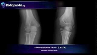 Elbow ossification centers CRITOE  radiology video tutorial [upl. by Ahcsap742]