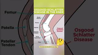 What is Osgood  Schlatter Disease physiotherapypainmodalitiesyoutube [upl. by Tilden765]