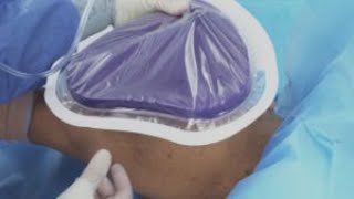 3M™ Prevena™ Therapy Tips and Tricks Video Orthopedic Shoulder [upl. by Casta]