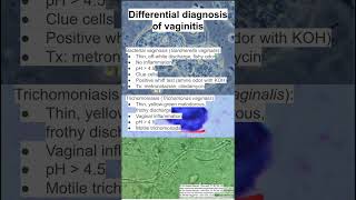 Differential diagnosis of vaginitis [upl. by Weitman]