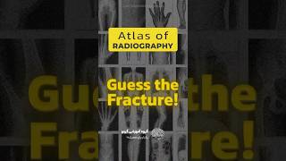 I’m sure you spotted the fracture in the image 👌👌 shorts medical orthopedics fracture [upl. by Dolphin923]