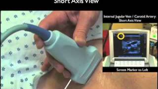 How To Ultrasound Guidance for Central Venous Access Part 1 Case Study [upl. by Cartan939]