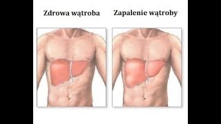 Zapalenie wątroby symptomy i dieta [upl. by Costanza]