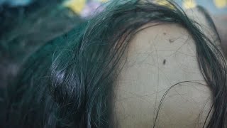 Nits and Lice Popping Sounds with Hand  Lice Infested [upl. by Ziul]