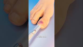 How Toenail Removal Works shorts 🙂 [upl. by Sik73]