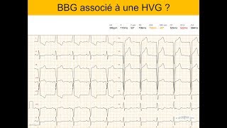 Hypertrophie ventriculaire gauche et bloc de branche  Quiz Dr Taboulet [upl. by Loats]