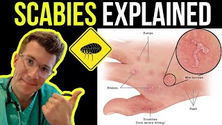 Doctor explains SCABIES skin rash including SYMPTOMS PHOTOS OF SKIN TREATMENT amp more [upl. by Aiuqram]