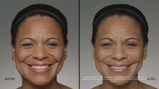 Restylane Dermal Filler  gorgeous [upl. by Aifoz]