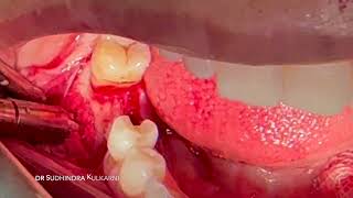 Implant placement with simultaneous GBR [upl. by Pinto]