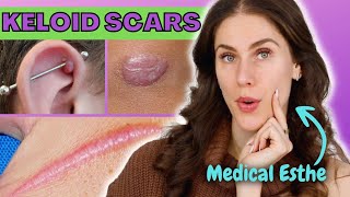 How To Treat Keloid Scars At Home  Is It Possible Why Do Keloid Scars Happen [upl. by Aidekal]