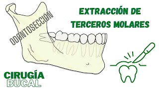 ODONTOSECCIÓN Técnica de extracción de Terceros Molares  Dr Han Choi [upl. by Calvert]