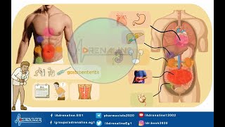 كل الي محتاج تعرفه عن تشخيص الم البطن Abdominal pain OTC [upl. by Paff]