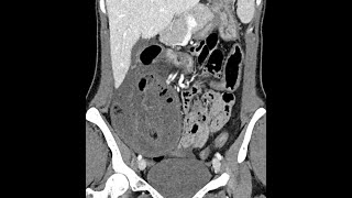 Small bowel ischemia associated with a parastomal hernia postileostomy in a Crohns disease patient [upl. by Ayatan541]