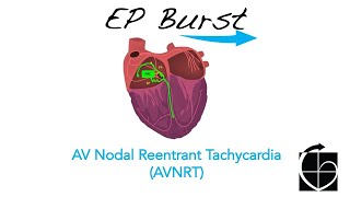 EP Burst AVNRT [upl. by Cirenoj]