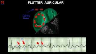 CURSO DE ELECTROCARDIOGRAFIA 55  FLUTTER Y FIBRILACIÓN AURICULARES [upl. by Aicsile]