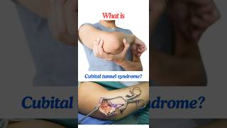 Cubital tunnel syndrome Ulnar neuropathy at the elbow shorts osborneband [upl. by Alisha100]