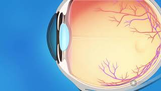 What is glaucoma [upl. by Kcuhc]