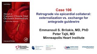 Case 106 Manual of CTO interventions Retrograde via epicardial collateral [upl. by Mcafee]