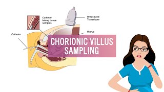 What is Chorionic Villus Sampling  CHORIONIC VILLUS SAMPLING  Narikaa [upl. by Ocnarf519]