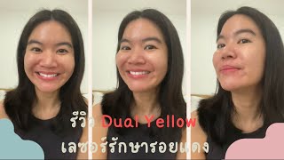 รีวิวเลเซอร์ dual yellow รักษารอยแดง [upl. by Arbmahs]