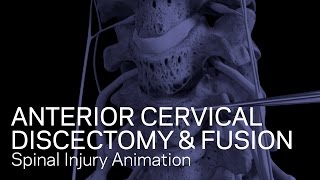 C56C67 Anterior Cervical Discectomy with Fusion [upl. by Aramal]