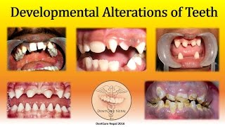 Developmental Defects of Teeth  Oral Pathology [upl. by Gar]