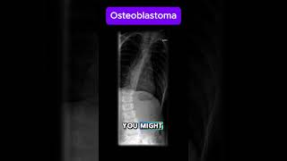 Osteoblastoma [upl. by Williamsen]