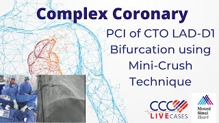 PCI of CTO LADD1 Bifurcation using MiniCrush Technique [upl. by Desdamonna]