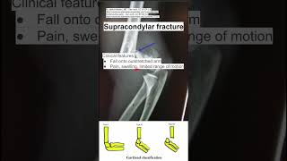 Supracondylar fracture [upl. by Gaal]