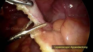 Laparoscopic Appendectomy  With In 6 Minutes  Step By Step  Day 75100 [upl. by Ettenor]