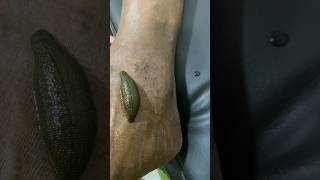 Leech Treatment at Ayurawa Healthcare ayurveda healnaturally [upl. by Nedap]