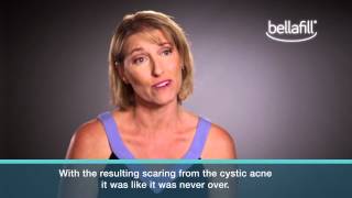 Bellafill® Acne Scar Patient Testimonials [upl. by Enahc155]