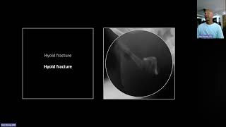 Fractures of the Cervical Spine  Free Radiology CME [upl. by Eleen]