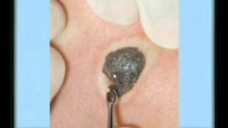 Seborrheic Keratosis Treatment [upl. by Ymeon400]