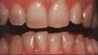 Dental Bleeching  White Teeth  beautiful results in Belgium [upl. by Amadus964]