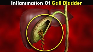 Cholecystitis Gallbladder Inflammation  Symptoms Causes and Treatment UrduHindi [upl. by Gerson]