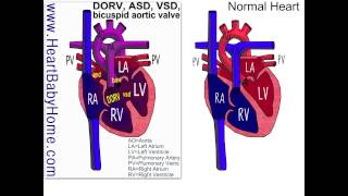 38 Double Outlet Right Ventricle with ASD VSD bicuspid aortic [upl. by Emmalee]