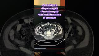 Cholelithiasis Hepatomegaly Prostatomegaly Abd wall Herniation of omentum trending ctscan [upl. by Noicpecnoc195]