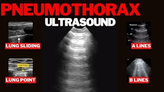 Pneumothorax on Ultrasound [upl. by Enileda222]