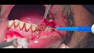 Verrucous carcinoma lip excision cautery laser  Dr Hitesh Patel [upl. by Saeger536]