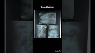 Ileus obstruksi xray radiology pemeriksaankesehatan bhojpuri [upl. by Tertia550]