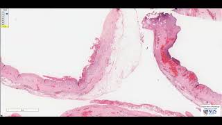 Heart Fibrinous pericarditis Microscopy  Talking Slide [upl. by Llennoc]